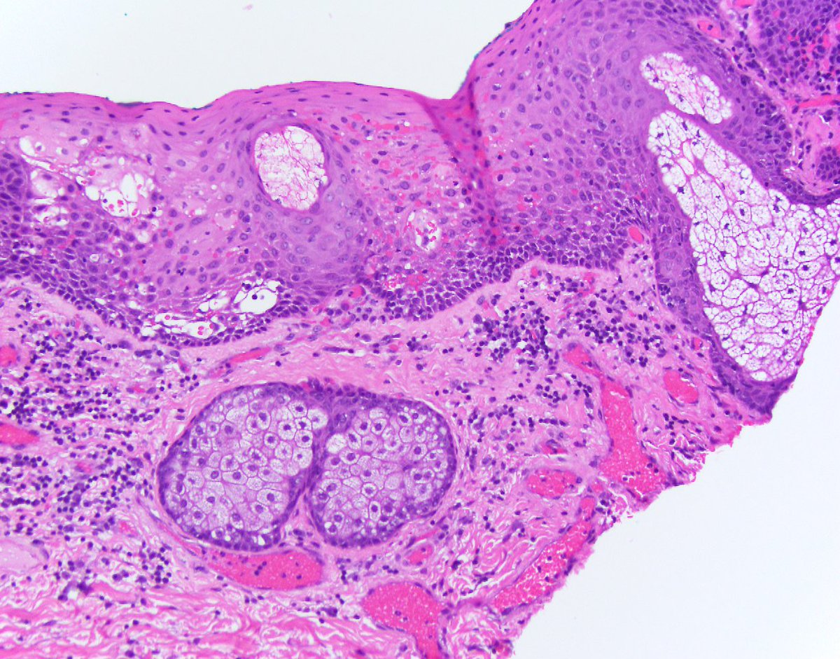 Fordyce Granules Histology