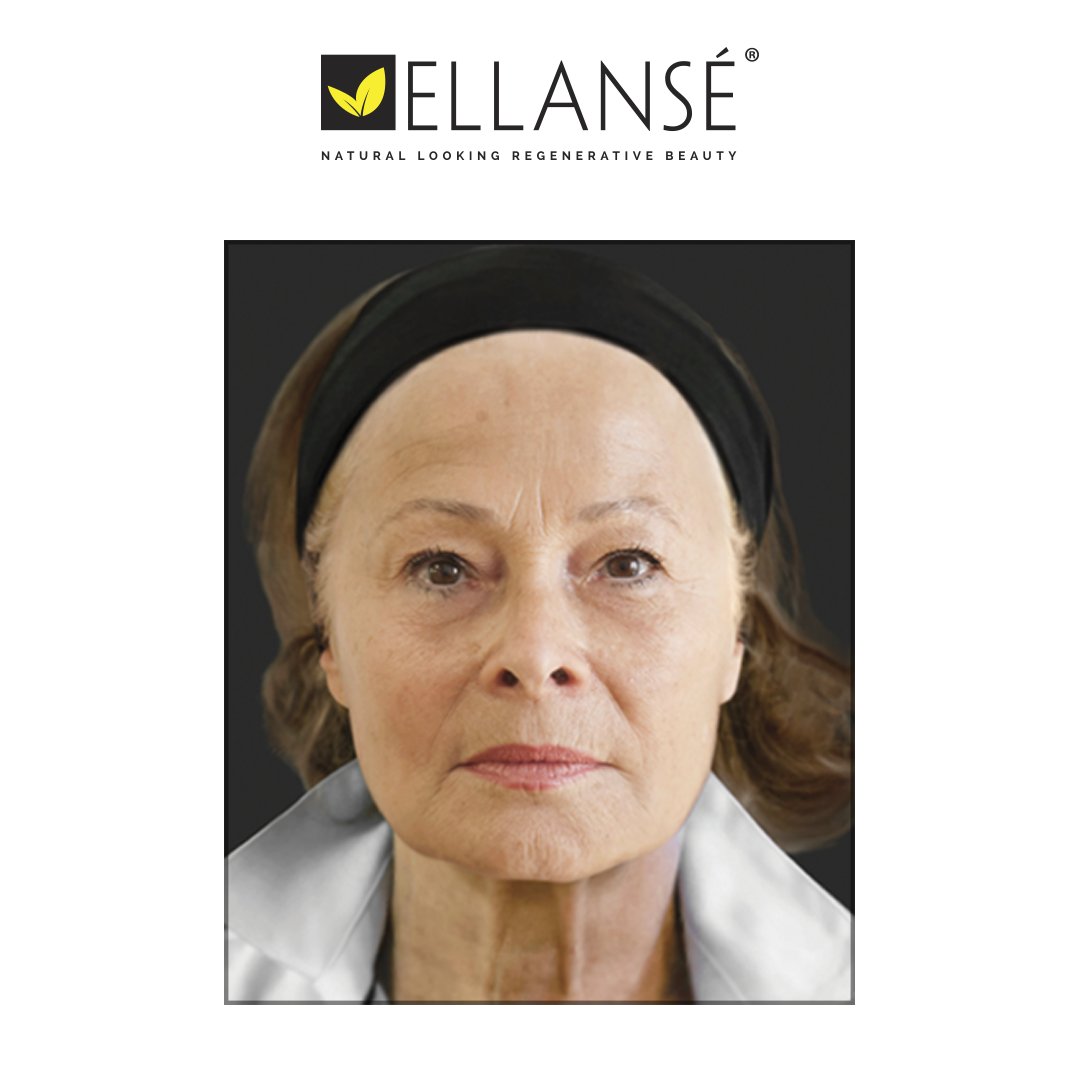 ellanseUK's tweet photo. How can Ellansé work for you? Explore more before and after images on our website. https://t.co/PKL19OrNA4 https://t.co/QiAYQw9nnf