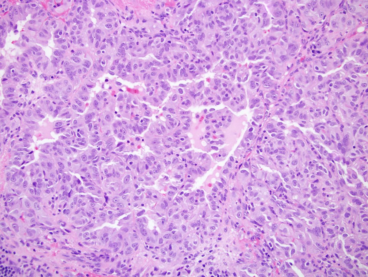 A new Mystery case has been posted on the home page #KidneyTumor. For case and diagnosis click here: pathologyoutlines.com/mysterycase.ht…