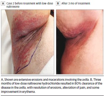 Case series suggests that low-dose #naltrexone may be a safe and effective treatment for #HaileyHaileyDisease ja.ma/2hnvphJ