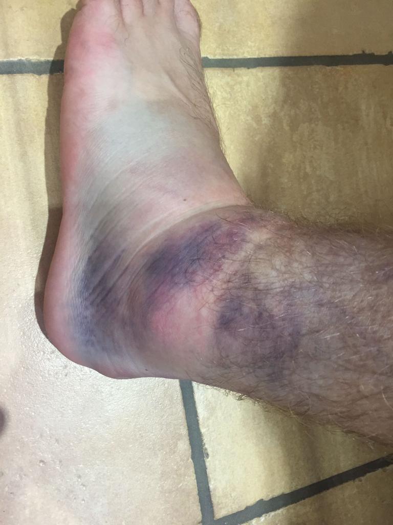 BardwellSC's tweet photo. News from the physio on @CDavey_93 - ligament damage and a sprain rather than a broken ankle means he misses rest of preseason for #recovery https://t.co/zxLstBzJqM
