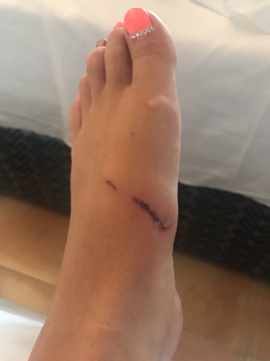 leahsmith204's tweet photo. Can't believe your shoes have done this to my feet, and I paid £50 for the privilege! @riverisland @riverislandhelp @RiverIslandPR https://t.co/Z5HNV6RqIv
