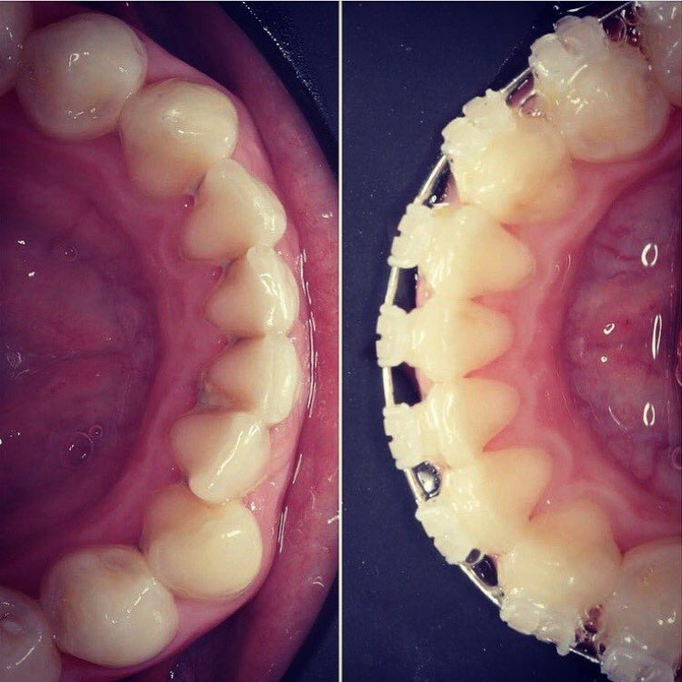 Gazgrimes's tweet photo. Crowding issue resolved with @QSTuk case carried out by @DavidBretton #dentistry #quickstraightteeth https://t.co/gC58MYm1Dp