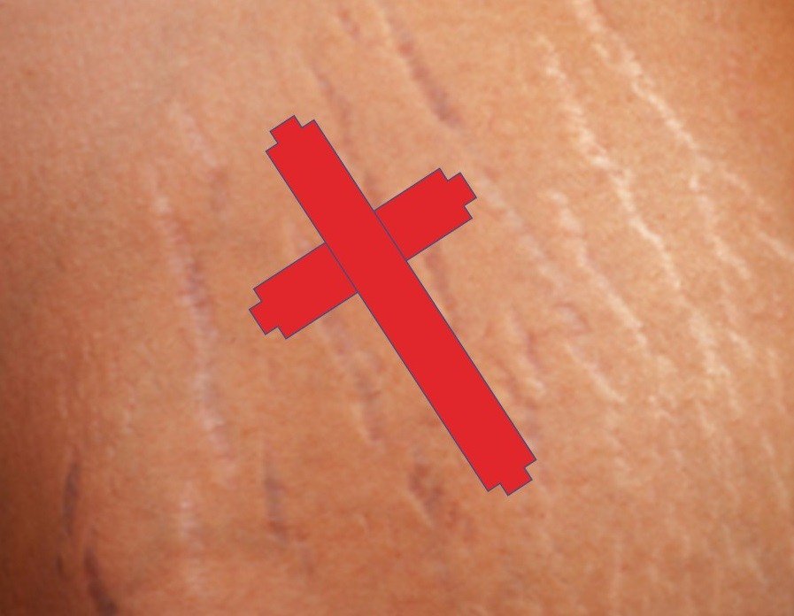 Stretch Marks …ingresurrectiontogether.wordpress.com/2017/08/03/str…