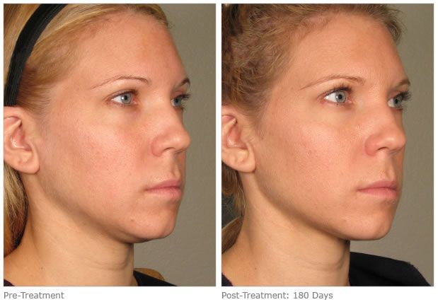 medispas10's tweet photo. Before and after chin reduction treatment. https://t.co/ja5DQ7K2Ir #SheffieldIsSuper #ChinReduction #NeckTightening https://t.co/XYg1PamM1y