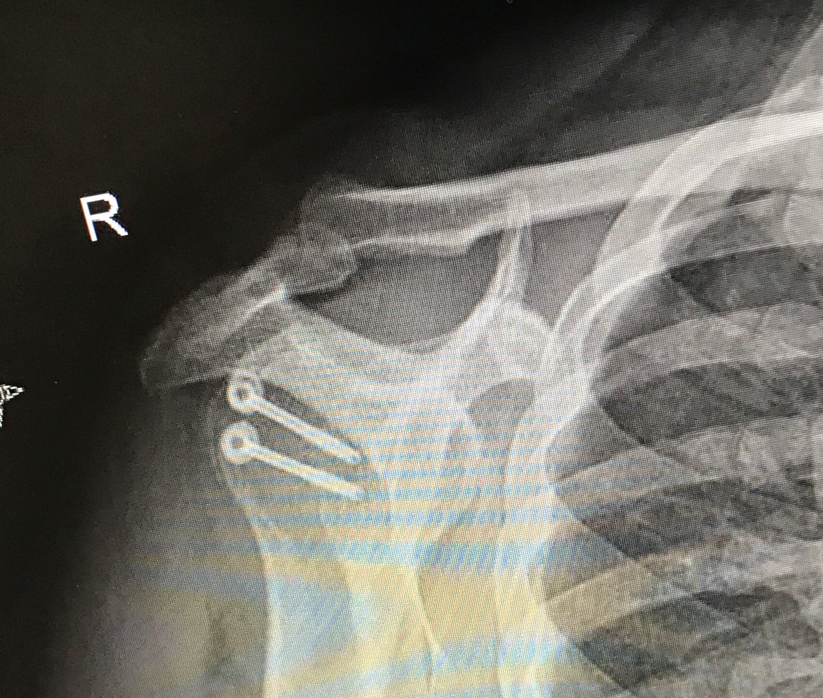 aytekin_celik's tweet image. Beim #Dieselskandal holst scheinbar ein #Softwareupdate , bei meiner Schulter half aber nur ein #hardwareupdate :-D