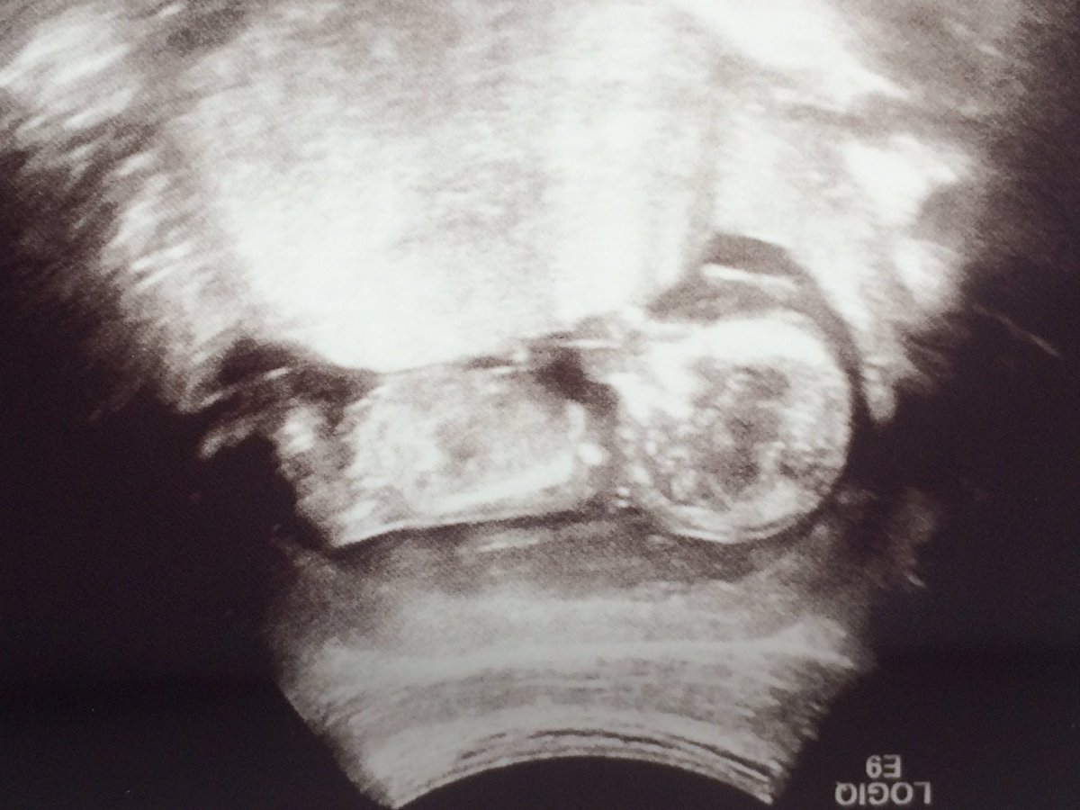 KingSportDesign's tweet photo. So not a golf post for a change but an exciting one nonetheless! A future major winner will be joining us in Feb! #futuretourpro #baby https://t.co/RH0R2lr2Af