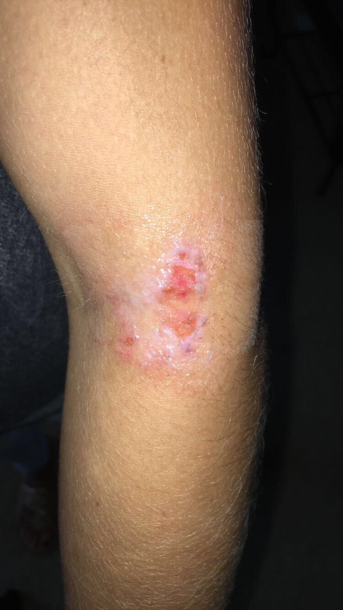 Wsoctv On Twitter Myrtlebeach Water Gave Me Flesh Eating Bacteria Nc Woman Says Https T Co Erlm0jxyxh