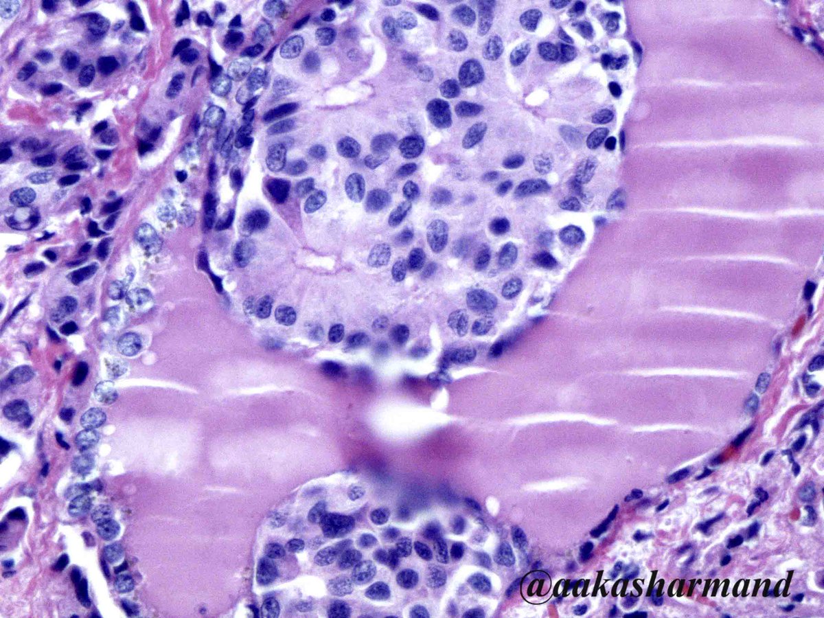 aakasharmand's tweet photo. Med-ThyCa obliterating thyroid follicles @ENTpathology @marcoslepe @marenwhymd @PennPathLabMed @gucer_hasan @BinXu16 @DianaEstherossi https://t.co/NozO8tMT8d
