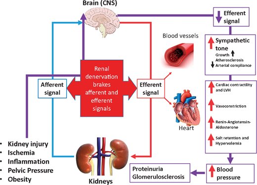 NDTsocial's tweet photo. Catheter-based renal denervation and #renal function: no evidence of harm but is there a hope of #nephroprotection? https://t.co/kL6WDWPyCZ https://t.co/wH3qFE3Vlp