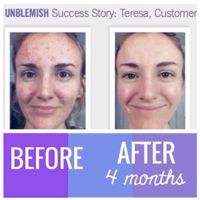 HCapra's tweet image. Don't believe the hype, over night zip zapping meds don't cure your acne. It takes time. And quality products. Unblemish is proven to work!