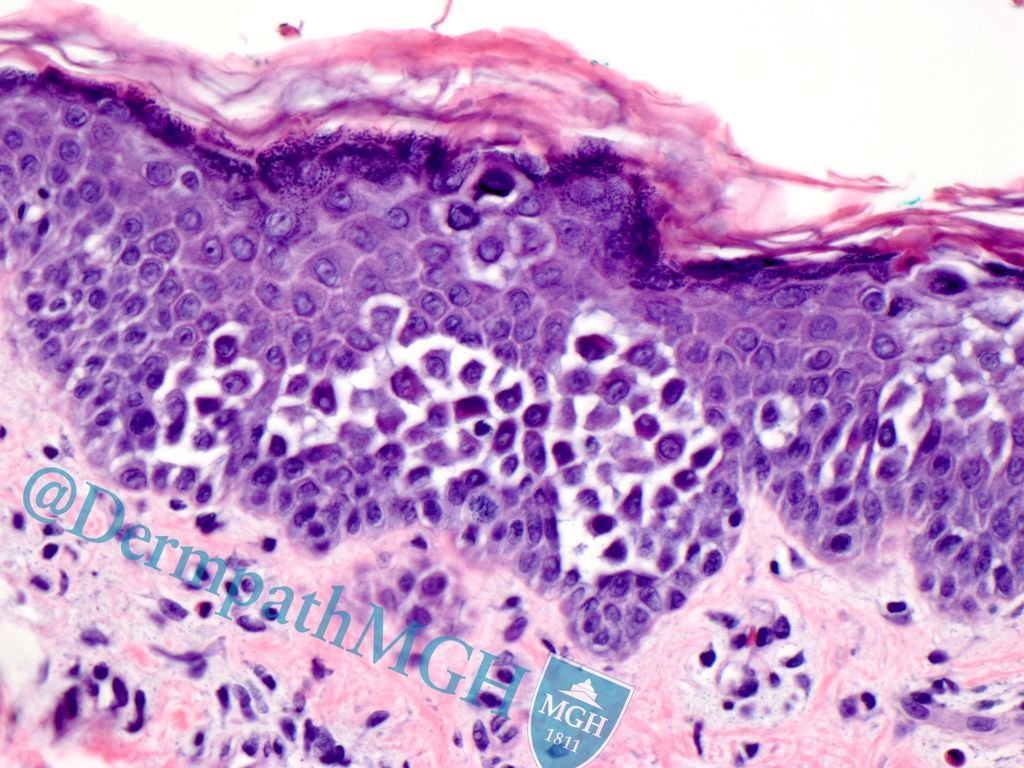 Relapsing &amp; recurring papules&amp;erosions linearly along Blaschko's lines: Relapsing linear acantholytic dermatosis #Dermpath #Pathology #Derm