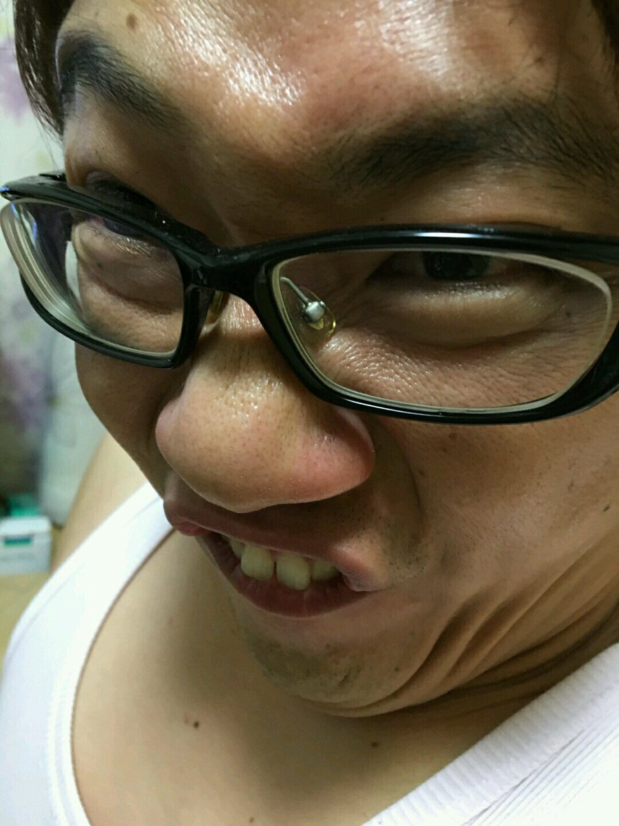 汚いハゲ