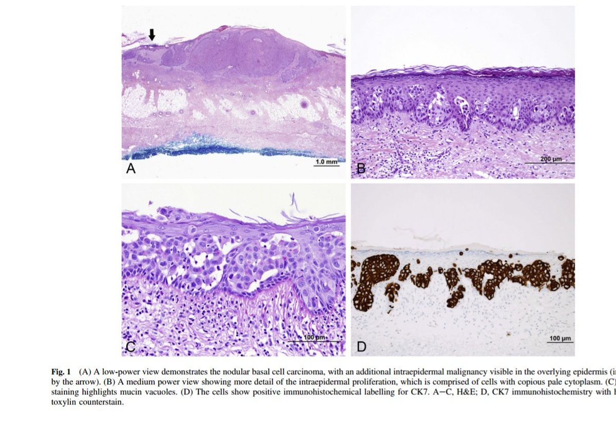 Benjamin Wood (@benjaminawood) on Twitter photo <a href="/AnnieMorrisonMD/">Annie O. Morrison MD</a> Here's a case <a href="/nathan_t_harvey/">Nathan Harvey</a> had of empd with BCC on the scalp ncbi.nlm.nih.gov/pubmed/?term=W… #dermpath #pathology #dermatology <a href="/AnnieMorrisonMD/">Annie O. Morrison MD</a> Here's a case <a href="/nathan_t_harvey/">Nathan Harvey</a> had of empd with BCC on the scalp ncbi.nlm.nih.gov/pubmed/?term=W… #dermpath #pathology #dermatology