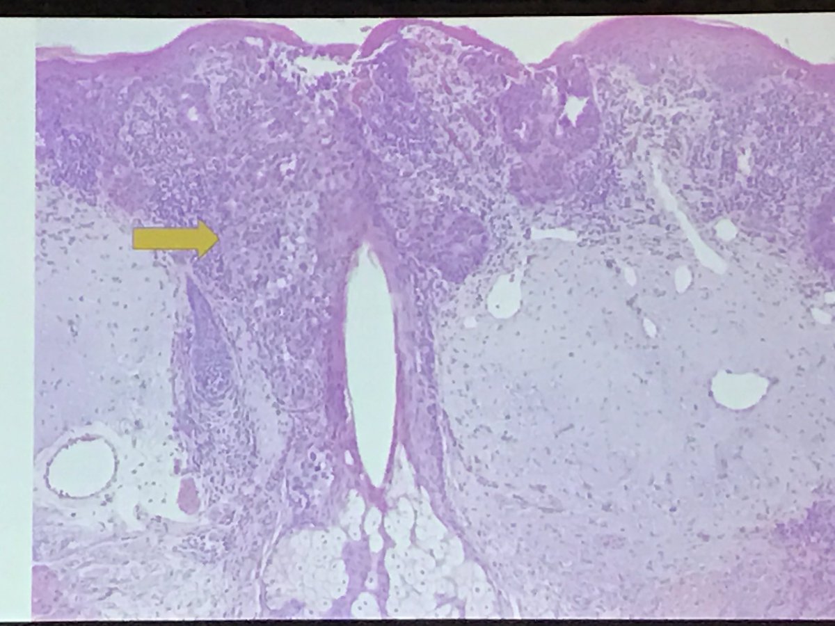 AnnieMorrisonMD's tweet photo. Dr Dipti Anand's rare case of ectopic extramammary Paget's on the cheek #PracticalSymposium17 #dermpath #dermatolgy #pathology https://t.co/AnaeRsaLlP
