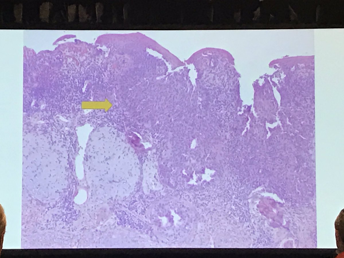 AnnieMorrisonMD's tweet photo. Dr Dipti Anand's rare case of ectopic extramammary Paget's on the cheek #PracticalSymposium17 #dermpath #dermatolgy #pathology https://t.co/AnaeRsaLlP
