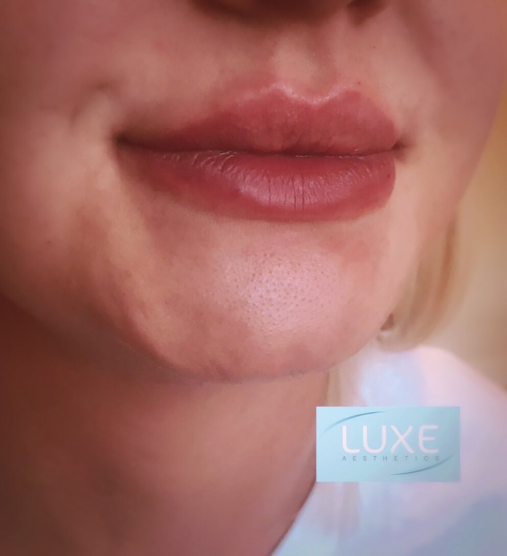 luxeaesthetics's tweet photo. 💋💋💋 lips @luxeaesthetics #lips #luxeaesthetics #pout #lipfiller #lipfillers #beautifullips https://t.co/hP53CFmX8g