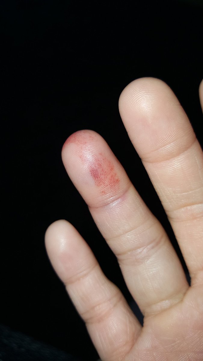 Fingers squashed. Can not move my finger and it hurts 😭
