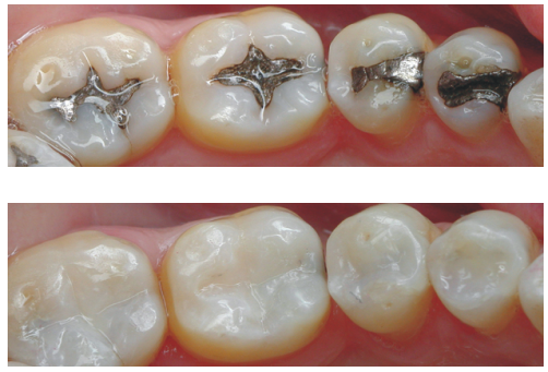 nashdentistry's tweet photo. We offer #compositefillings that are made to match the shade of your teeth. No more unsightly #metalfillings that detract from your smile! https://t.co/JiK1RwLnBj