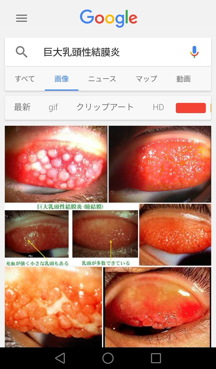 もえ On Twitter コンタクト 取りに病院行って 目ゴロゴロするって伝えたら先生に瞼ひっくり返されて したら巨大乳頭性結膜炎なってるとか言われて超怒られたし もうカラコンだめ 言われて 治るまでコンタクト禁止 受け取りすら出来なかったし後で調べたら画像