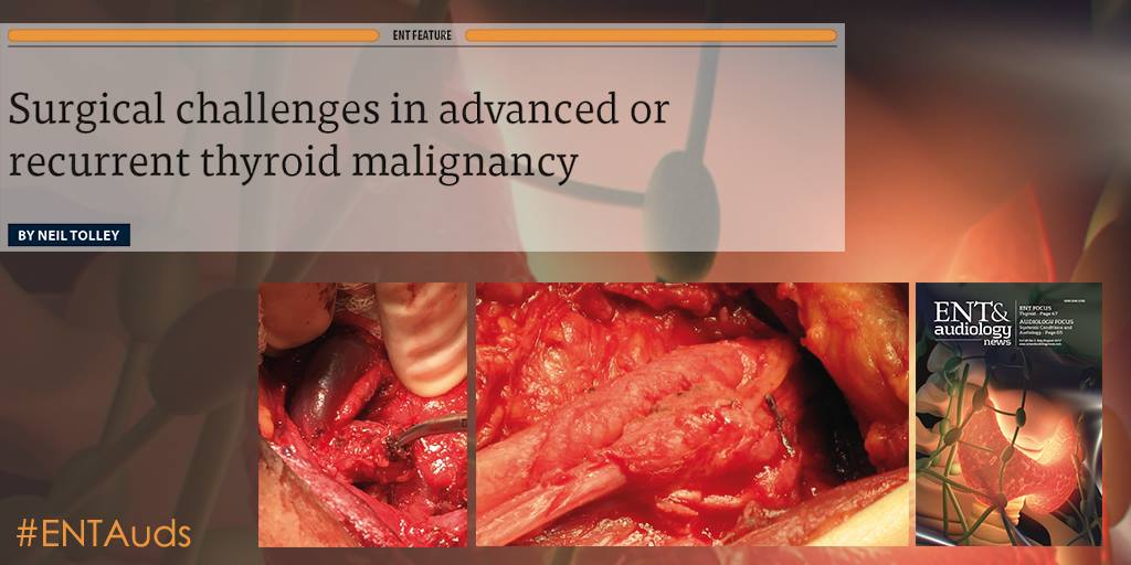 ENT_AudsNews's tweet photo. In the UK, 16% of #thyroidectomies are performed for #cancer. The majority are for differentiated cancer https://t.co/pK1ypdhzcv #ENTSurgery https://t.co/UfWoR0N1hm