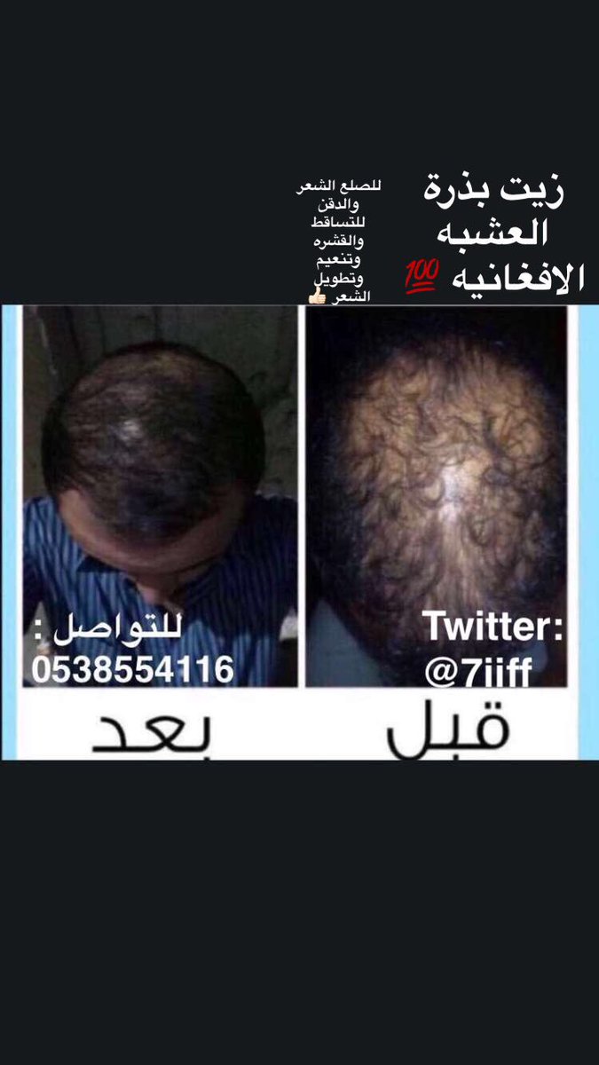 7iiff's tweet photo. زيت الحشيش الافغاني 💯
لجميع مشاكل الشعر والدقن
صلع ،تساقط ،تنعيم ،تطويل

الرياض وجده يد بيد 🚗

للتواصل 📲0538554116
 #هالة_الأزرق https://t.co/L1P1gj9S83