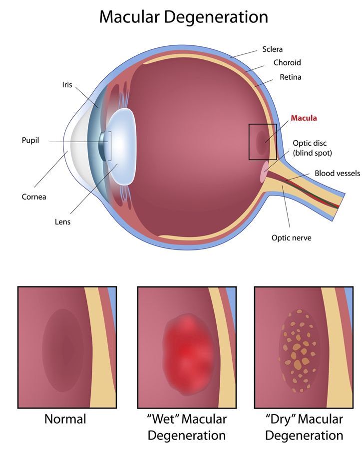 ClinicasQvision's tweet photo. "Nuevos fármacos para #DMAE podrían reducir el número de inyecciones"
Blog @FWaisen https://t.co/ztN6SpV182 https://t.co/EpddwtcNwn