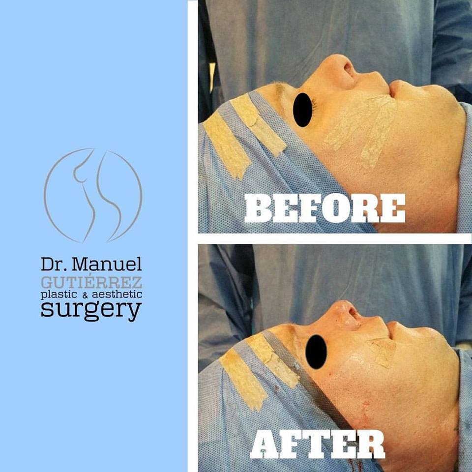 T - Dr. Manuel Gutierrez, Plastic Surgery in Tijuana Mexico