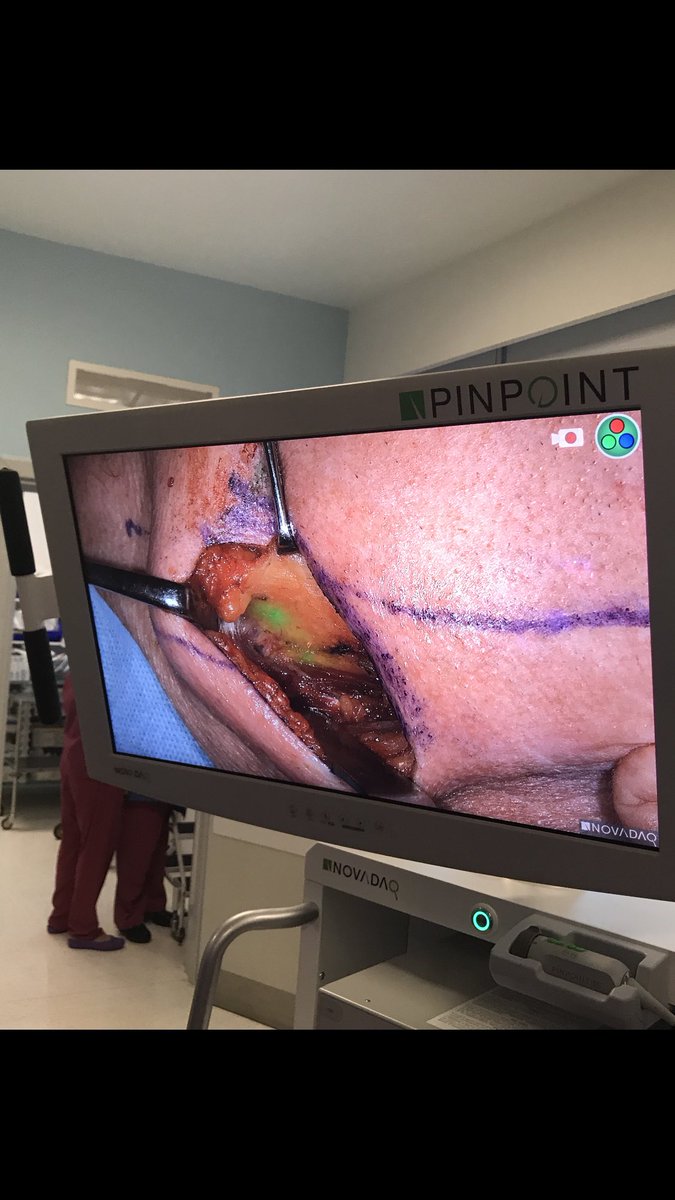 ManishChandSurg's tweet photo. Fabulous morning w/ Prof McGurk sentinel nodes in tongue ca. ICG & Gamma probe @StrykerEndo @NOVADAQTech @UCLDivofSurgery @GENIE_UCL https://t.co/84E6osbo6M