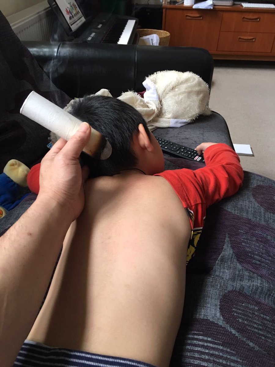 朋友用我做的艾条给孩子灸身柱穴👍