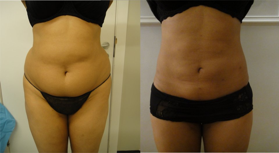 privateclinic's tweet photo. MicroLipo is perfect for targeting stubborn areas leaving you more confident to wear exactly what you want #TPCTLC #Liposuction https://t.co/iRiDl7a3Xp