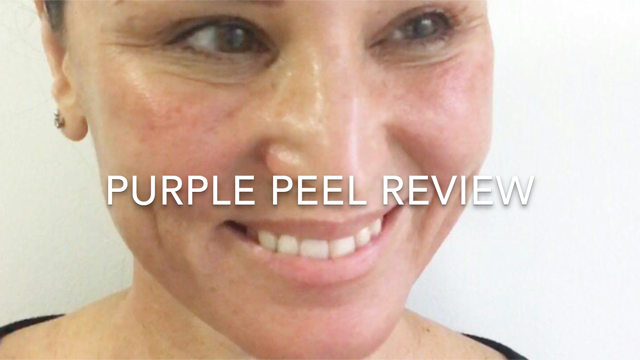 RedcliffeStyle's tweet image. Beauty: My Purple Peel Experience redcliffestyle.com/beauty-purple-…