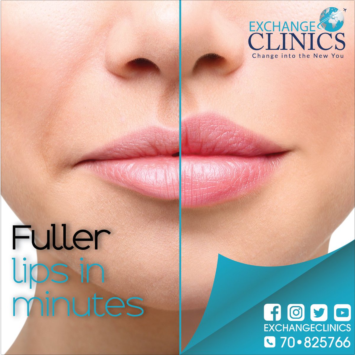 exchangeclinics's tweet photo. Fuller lips in minutes
#Botox_injection
#Exchange_Clinics change into the new you
for more info call +961 70 825 766 https://t.co/MNHrvhvYdu