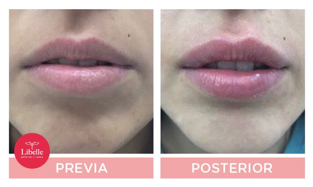 Animate a lucir labios más sexys!!! 
El relleno con ácido hialurónico da un efecto natural y armónico
Foto gentileza Dra Samanta Wajnfeld