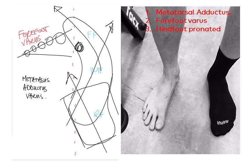 Cyclefit ICS (@cyclefitics) on Twitter photo The hardest foot to work with in bike-fitting - Metatarsal-Adductus. Luckily <a href="/mickhabgood/">Mick Habgood</a> in session - sketch shows Contradictory Mechanics The hardest foot to work with in bike-fitting - Metatarsal-Adductus. Luckily <a href="/mickhabgood/">Mick Habgood</a> in session - sketch shows Contradictory Mechanics