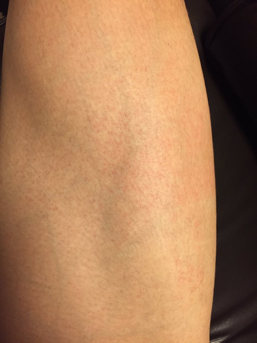 コリン性蕁麻疹患者 医学生 Dm大歓迎 例年 夏は症状が緩和し 汗をかいても蕁麻疹が出ないのが自分コリン性蕁麻疹 だった しかし 今年は症状が緩和せず蕁麻疹もしっかり出ている 写真は右太もも