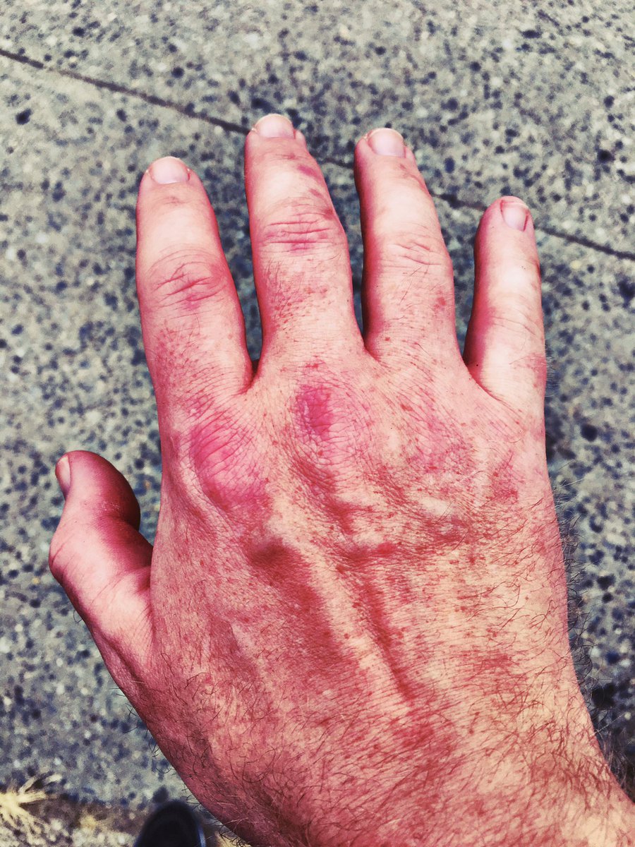 iamwaynegilbert's tweet photo. Part two of injuries... street photography can get rough. 👋😂#photographerslife #imaokay #healed #happy #handyagain https://t.co/8UGY28Hlsf