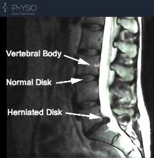 FPHYSIOTHERAPY's tweet photo. چگونه بفهمیم بیرون زدگی دیسک کمر داریم؟
https://t.co/UlNrs5hpUD
#PhysicalTherapy #physiotherapist #herniated_disk https://t.co/0nKDZeap3p