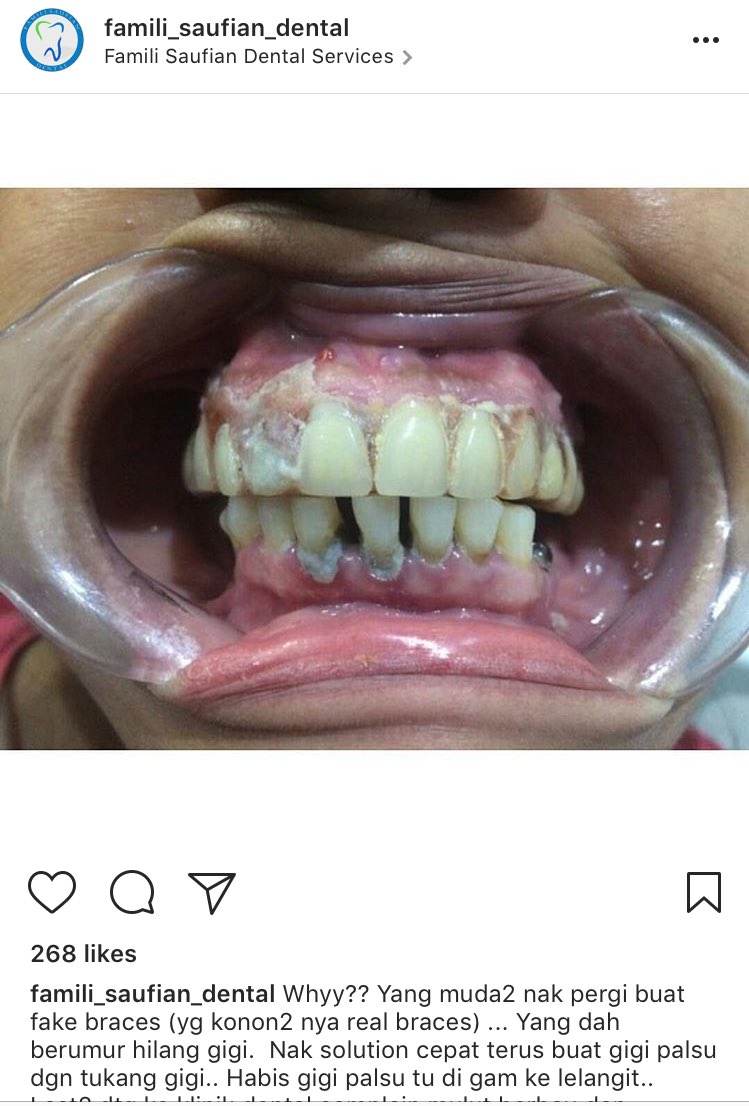 Fake teeth user is now go to real dental clinic to remove. Look at the teeth condition now 😞😷