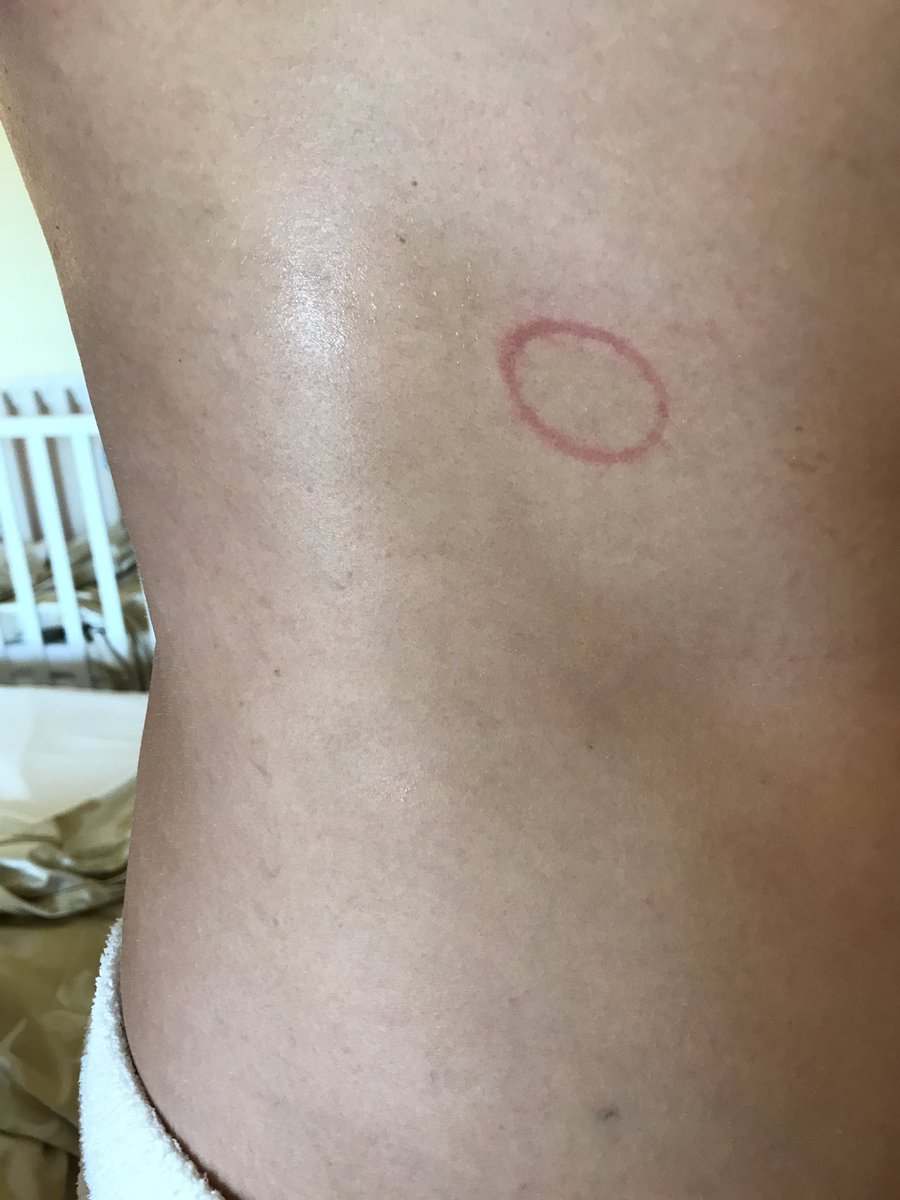 IAmChrisRamsey's tweet photo. Anyone else also have this mark on their torso after the eclipse? #ChosenOne #RingOfDestiny #SleptOnABottleCap https://t.co/WayArBX1WO