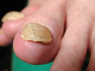 MedicalPedi's tweet photo. Trauma can cause nails to grow back differently and in some cases thick and discoloured. Call us today for an assessment! #medicalpedicure https://t.co/jhCn2moZRL