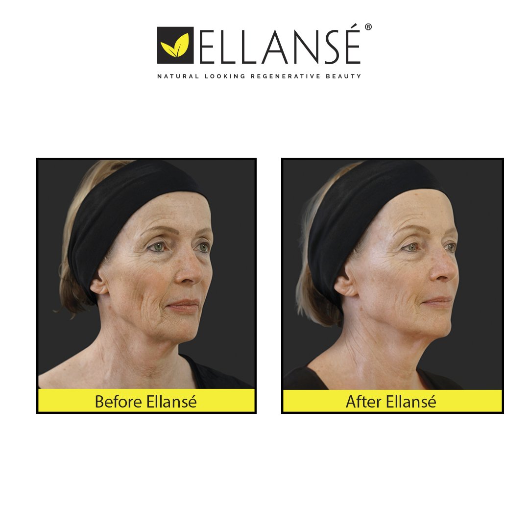 ellanseUK's tweet photo. Ginette was treated with Ellansé in her temples, cheeks and nasolabial folds to subtly turn back the clock and rejuvenate her image. https://t.co/QHeKQixjjD