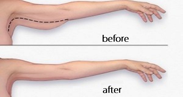 HealthTips565's tweet image. Want to get sexy arms. Visit here - bit.ly/2vfEmw3