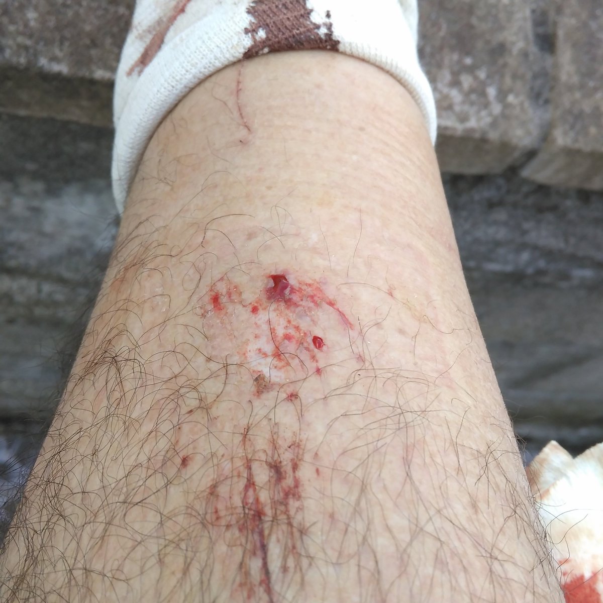 Haven't tweeted for yrs today's climbing injury love a hole in my leg