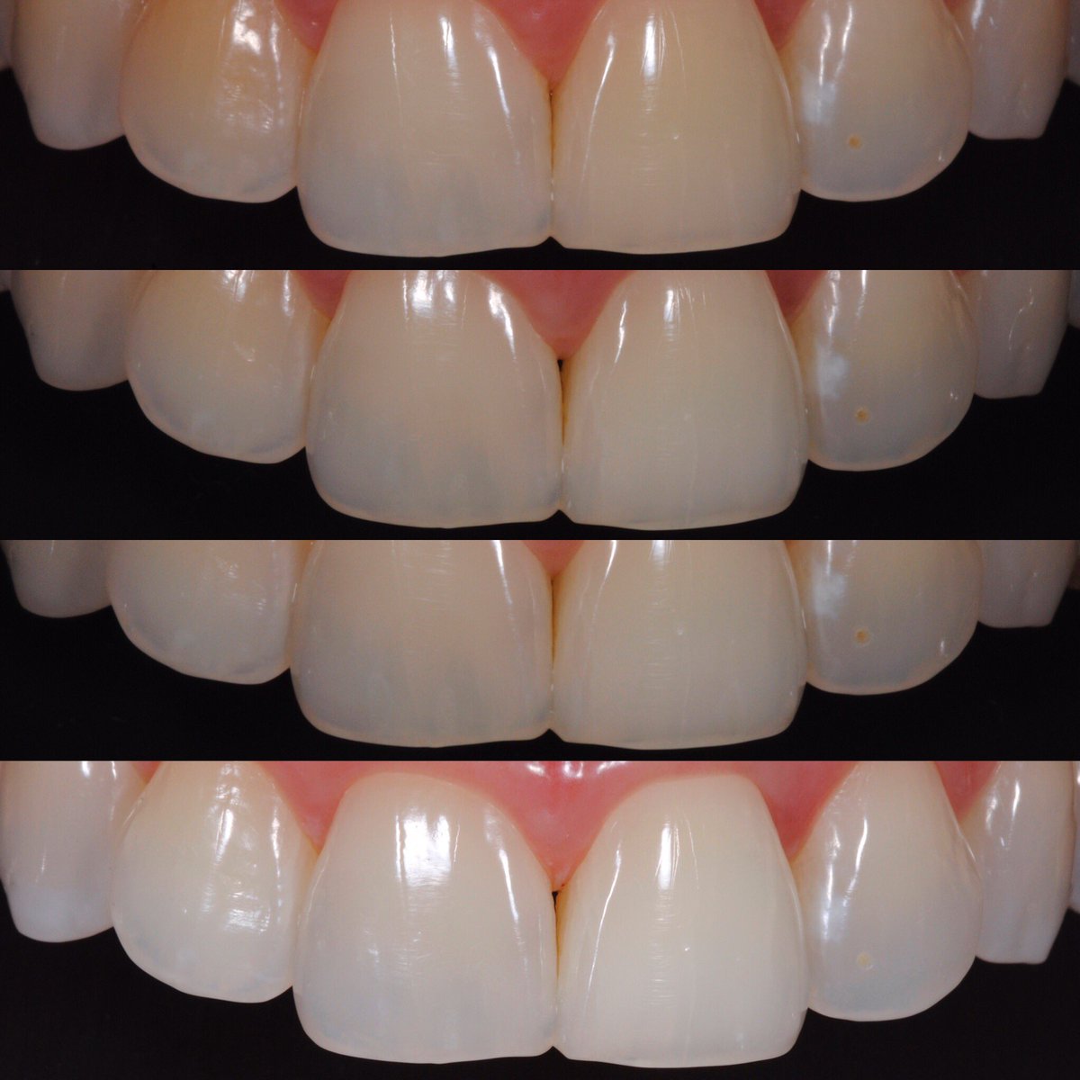 restorativeDS's tweet photo. Two dark teeth? Follow same instructions for single dark tooth! #thinkC https://t.co/0DWxyQiPcK