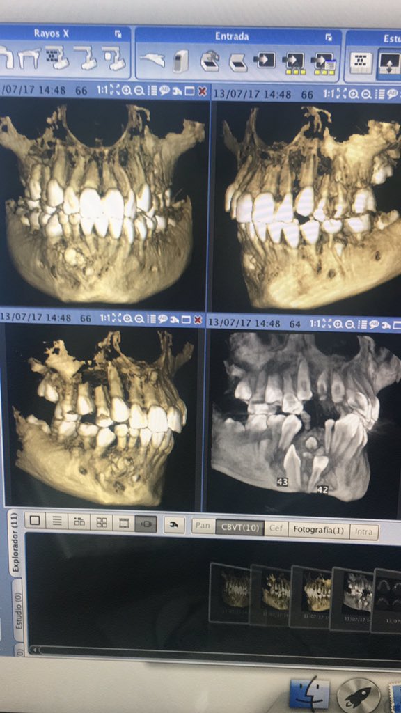 puntosalud3d's tweet photo. Paciente Femenina de 10 años de edad con dientes inferiores retenidos https://t.co/ShydnzcKSG