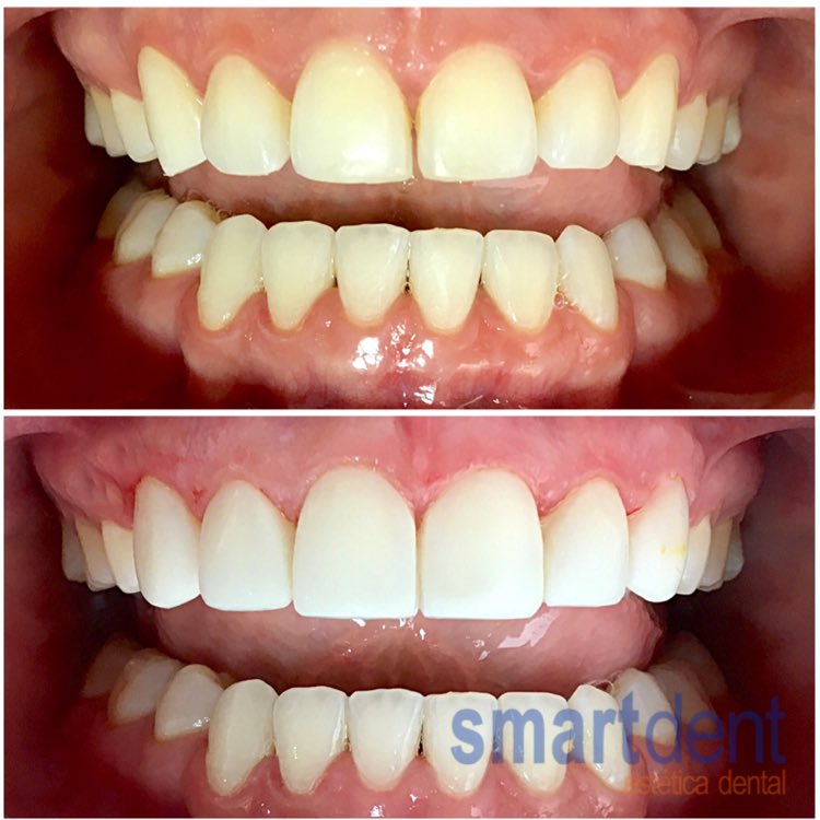monicabarrerog's tweet photo. Diseños de sonrisa muy naturales, la paciente queria lucir unos dientes mas blancos y parejos. #smartdent https://t.co/VP2SDKstoY