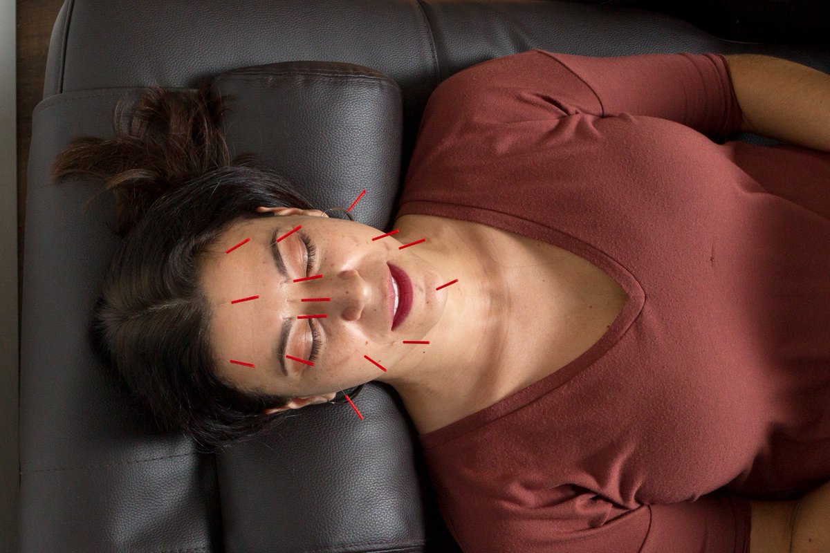 MA_modernacu's tweet photo. #DYK: Puffiness under the eyes can have many causes that can be treated with #Acupuncture https://t.co/dr19Q6QhyB #ModernAcupuncture #CosAcu https://t.co/oAbKWULGit