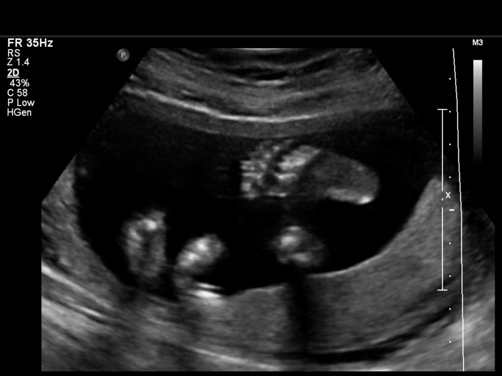 ThePrime714's tweet photo. Can't wait til little man gets here! #november15 #BABYBUMP #6monthspregnant #foot #ultrasound #drewdixon 💙💕💙 https://t.co/sRwuy789jm