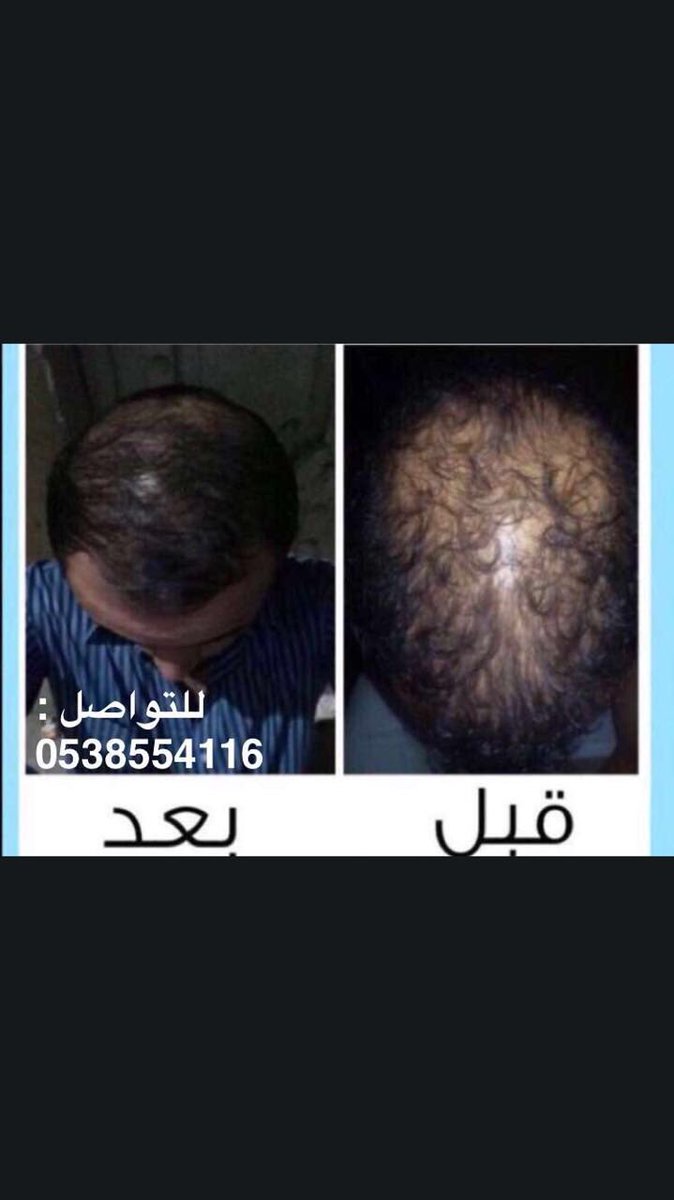 7iiff's tweet photo. زيت الحشيش الافغاني 💯
لجميع مشاكل الشعر والدقن
صلع ،تساقط ،تنعيم ،تطويل

الرياض وجده يد بيد 🚗
للتواصل 📲0538554116
 #ندري_انك_تحب_السفر https://t.co/DTbNb2TJMI
